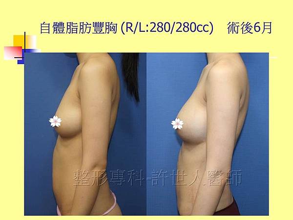 自體脂肪隆乳豐胸(R/L:280/280cc) 術後6個月