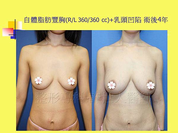 自體脂肪隆乳豐胸(R/L2360/360cc)+乳頭台凹陷 術後4年