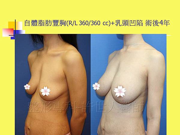 自體脂肪隆乳豐胸(R/L2360/360cc)+乳頭台凹陷 術後4年