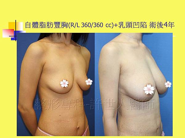 自體脂肪隆乳豐胸(R/L360/360cc)+乳頭台凹陷 術後4年