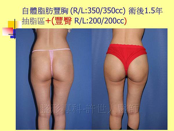 自體脂肪豐胸術後1.5年-6