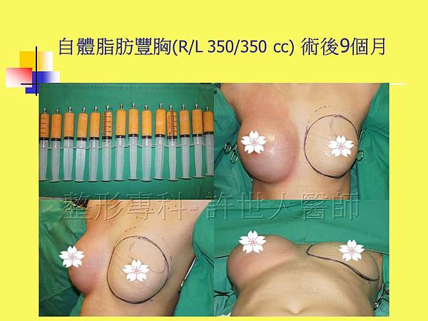 自體脂肪豐胸術後9個月-4