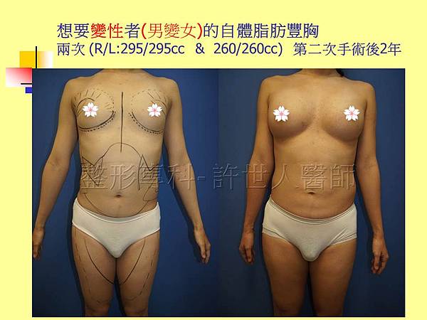 男變女的自體脂肪豐胸-0