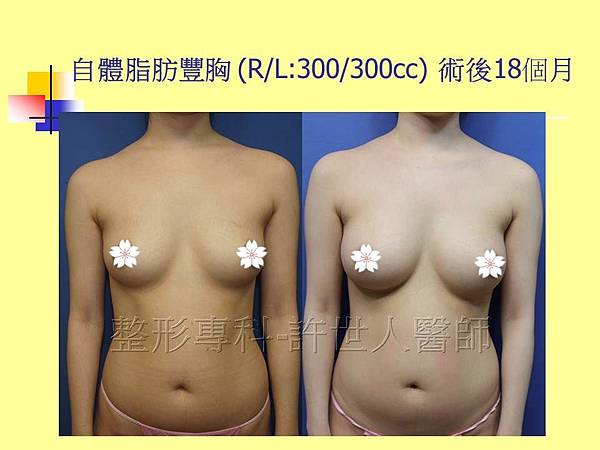 自體脂肪隆乳豐胸(R/L300/300cc) 術後18個月