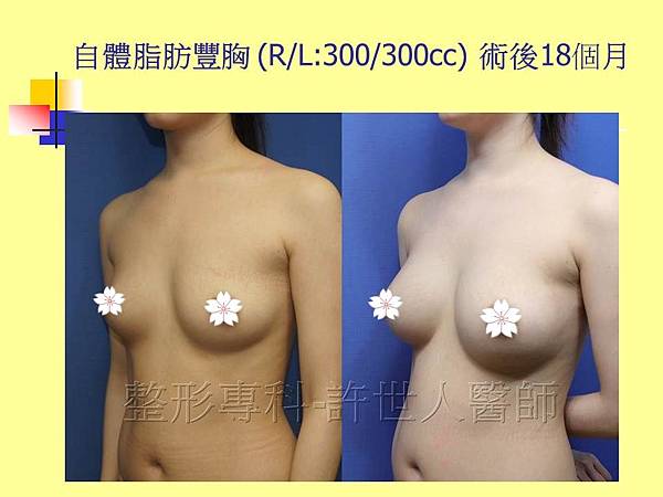 自體脂肪隆乳豐胸側面(R/L300/300cc) 術後18個月
