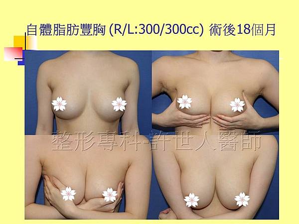 自體脂肪隆乳豐胸(R/L300/300cc) 術後18個月