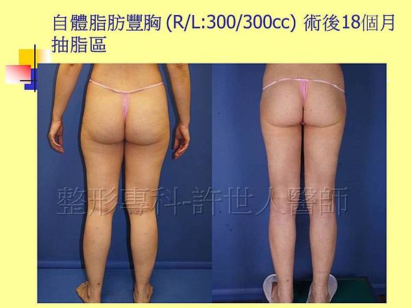 自體脂肪豐胸-術後18個月-抽脂區