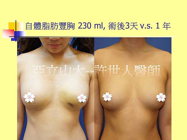自體脂肪豐胸(R/230 L/230cml) 術後1年