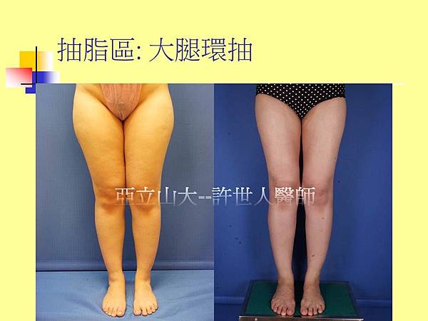 自體脂肪豐胸_抽脂區:大腿環抽