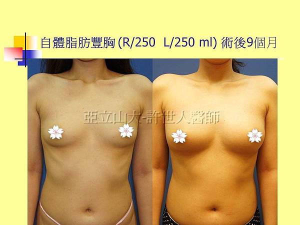 自體脂肪豐胸250cc-術後9個月-1