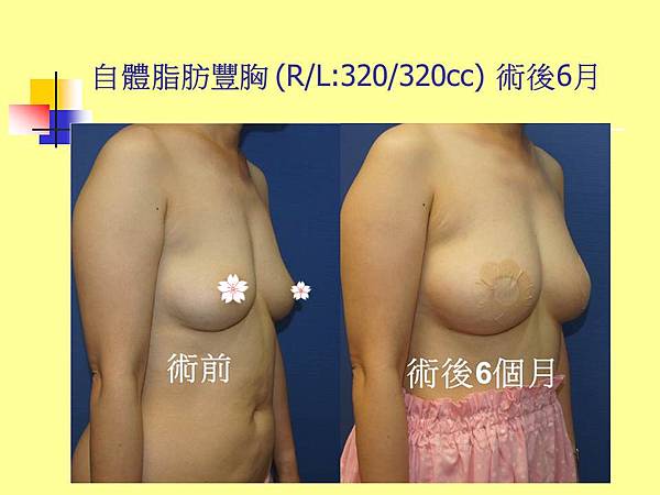 自體脂肪隆乳 豐胸(R/L:320/320cc) 術後6個月