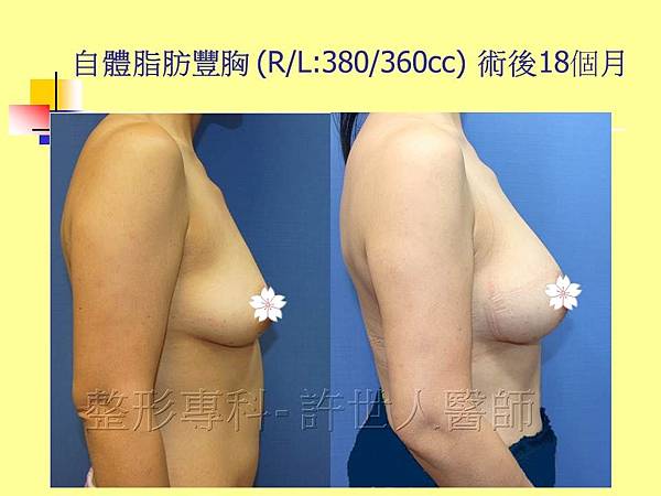 自體脂肪隆乳豐胸(R/L:380/360cc) 術後18個月