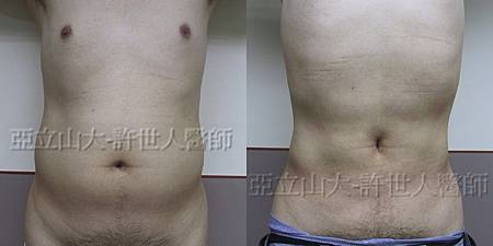 六塊肌 A 術前術後2個月