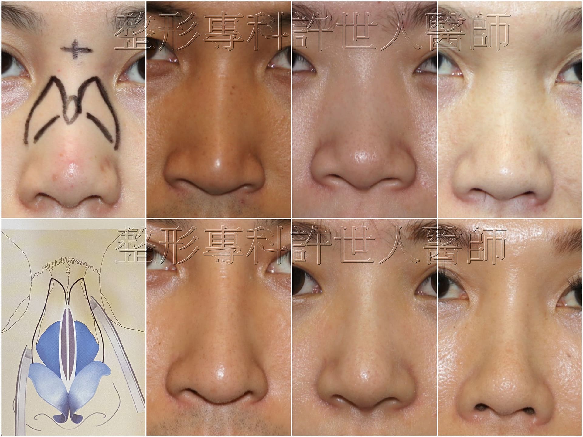 Three-section-structure-rhinoplasty_11