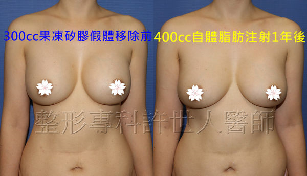 假體取出自體脂肪移植豐胸