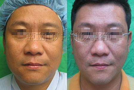 羅丹轉世? <全方位抽脂達人的誕生> 21 1.臉部 抽脂