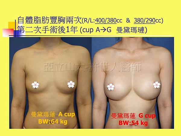 羅丹轉世? <全方位抽脂達人的誕生> 76 b.自體脂肪豐胸2次 1