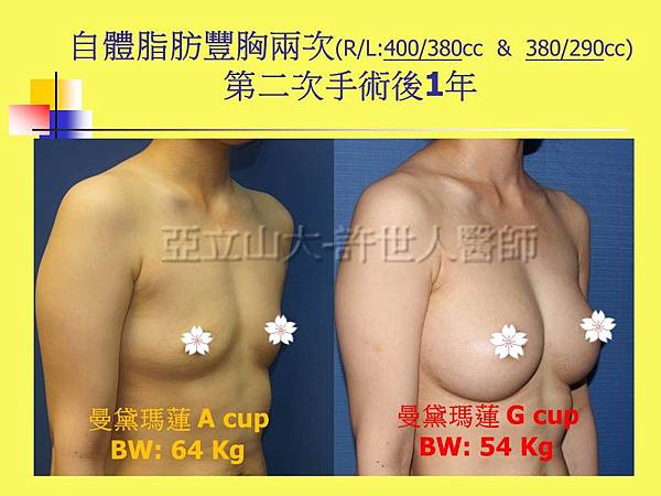 羅丹轉世? <全方位抽脂達人的誕生> 77 b.自體脂肪豐胸2次 2