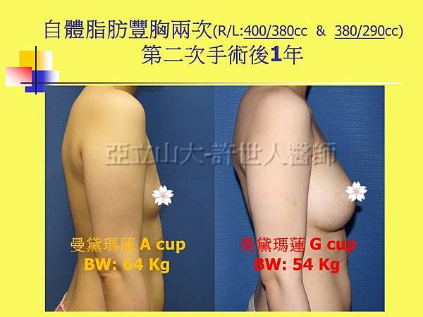 羅丹轉世? <全方位抽脂達人的誕生> 78 b.自體脂肪豐胸2次 3