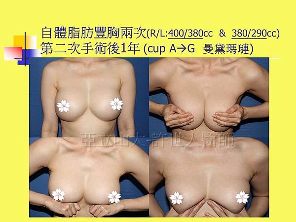 羅丹轉世? <全方位抽脂達人的誕生> 79 b.自體脂肪豐胸2次 4