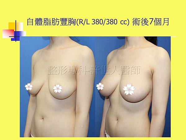 羅丹轉世? <全方位抽脂達人的誕生> 83 c.自體脂肪豐胸術後7個月 4