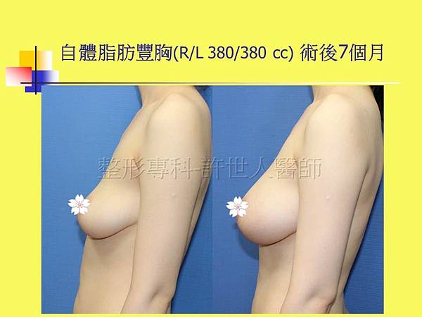 羅丹轉世? <全方位抽脂達人的誕生> 84 c.自體脂肪豐胸術後7個月 5