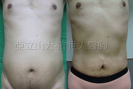 為整形名醫鄭孝威成功抽脂變身型男秘辛大公開 5 為整形名醫鄭孝威成功抽脂塑身秘辛大公開 4