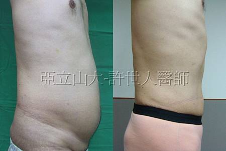 為整形名醫鄭孝威成功抽脂變身型男秘辛大公開 6 為整形名醫鄭孝威成功抽脂塑身秘辛大公開 5