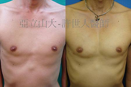 羅丹轉世? <全方位抽脂達人的誕生> 94 胸肌整形