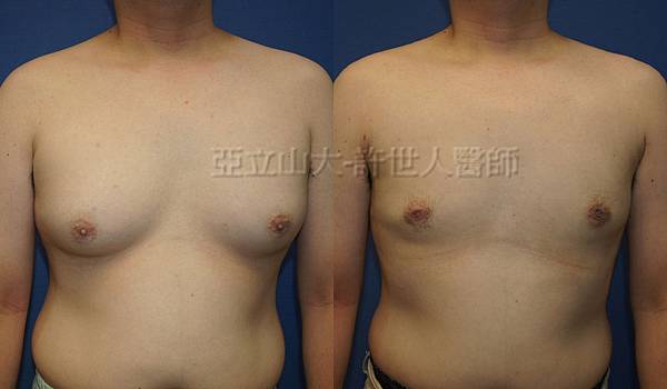 「你是我胸口永遠的痛」? 倘開心胸談「男性女乳症」! 146 男性女乳症 許世人醫師案例分享 01