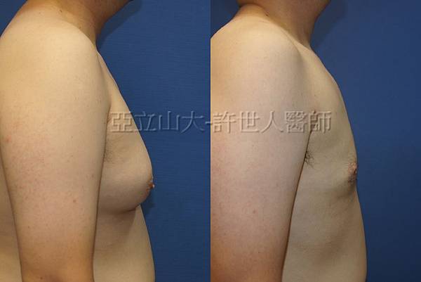 「你是我胸口永遠的痛」? 倘開心胸談「男性女乳症」! 147 男性女乳症 許世人醫師案例分享 02