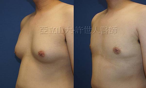 「你是我胸口永遠的痛」? 倘開心胸談「男性女乳症」! 148 男性女乳症 許世人醫師案例分享 03