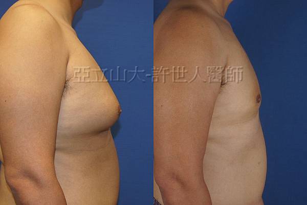 「你是我胸口永遠的痛」? 倘開心胸談「男性女乳症」! 145 男性女乳症 許世人醫師案例分享 3