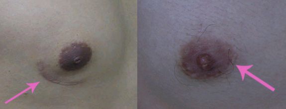 「你是我胸口永遠的痛」? 倘開心胸談「男性女乳症」! 129 男性女乳症乳房切除術