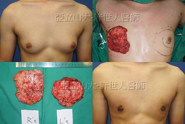 「你是我胸口永遠的痛」? 倘開心胸談「男性女乳症」! 141 男性女乳症乳房切除術許世人醫師 1