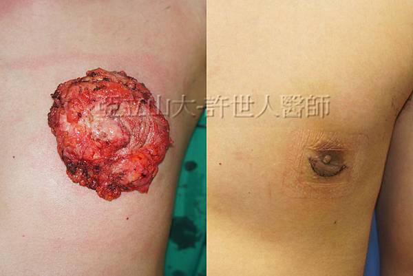 「你是我胸口永遠的痛」? 倘開心胸談「男性女乳症」! 142 男性女乳症乳房切除術許世人醫師 2