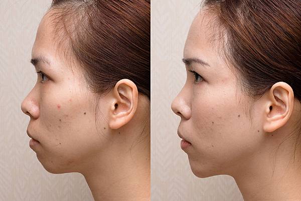 自體脂肪全臉雕塑 許世人醫師案例分享 04