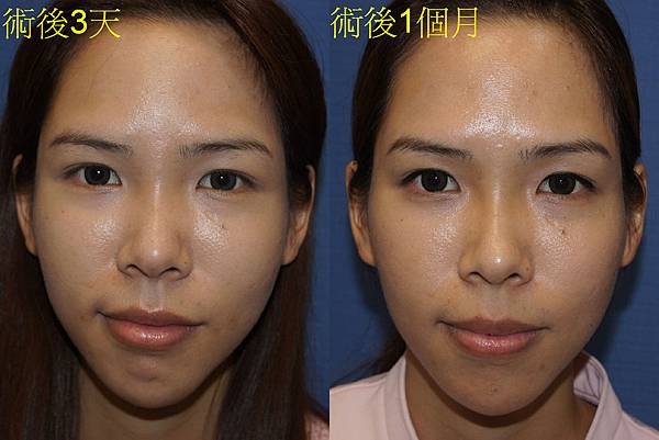 自體脂肪全臉雕塑 許世人醫師案例分享 05
