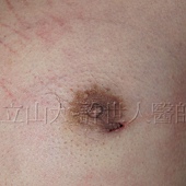 金蟬脫殼式的乳房腺體切除術許世人醫師 1