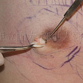 「你是我胸口永遠的痛」? 倘開心胸談「男性女乳症」! 132 金蟬脫殼式的乳房腺體切除術許世人醫師 2