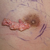 金蟬脫殼式的乳房腺體切除術許世人醫師 3