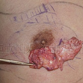 「你是我胸口永遠的痛」? 倘開心胸談「男性女乳症」! 135 金蟬脫殼式的乳房腺體切除術許世人醫師 4