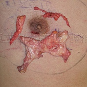 金蟬脫殼式的乳房腺體切除術許世人醫師 5