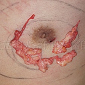 「你是我胸口永遠的痛」? 倘開心胸談「男性女乳症」! 138 金蟬脫殼式的乳房腺體切除術許世人醫師 6