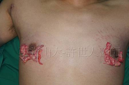 「你是我胸口永遠的痛」? 倘開心胸談「男性女乳症」! 139 金蟬脫殼式的乳房腺體切除術許世人醫師 7