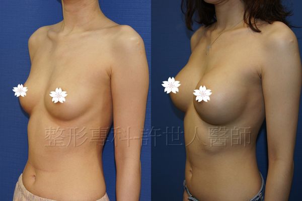 水蜜桃果凍矽膠隆乳(全程內視鏡)手術案例分享