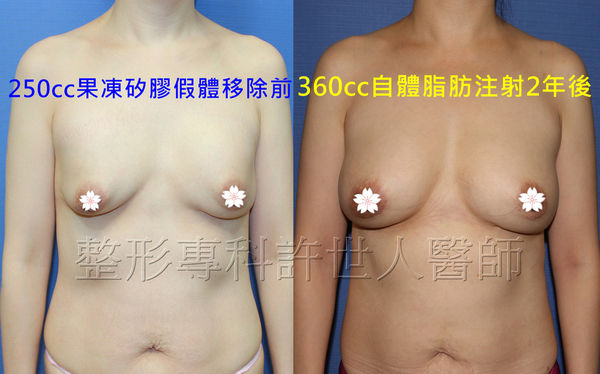 拯救矽膠假體隆乳失敗的新方法—SIEF假體脂肪置換隆乳術