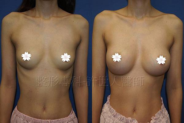 水蜜桃果凍矽膠隆乳(全程內視鏡)手術案例分享