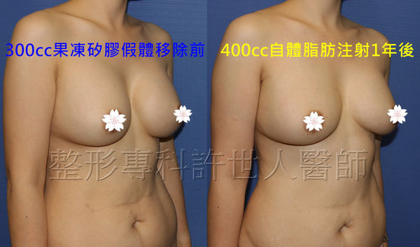 拯救矽膠假體隆乳失敗的新方法—SIEF假體脂肪置換隆乳術