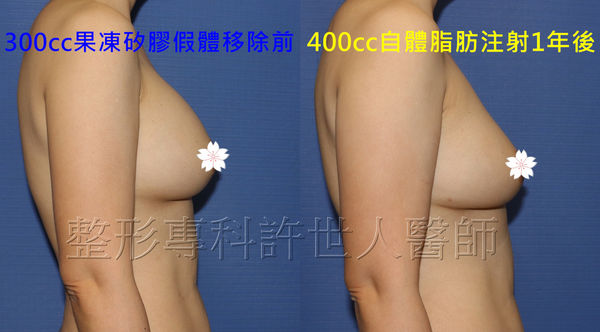 拯救矽膠假體隆乳失敗的新方法—SIEF假體脂肪置換隆乳術
